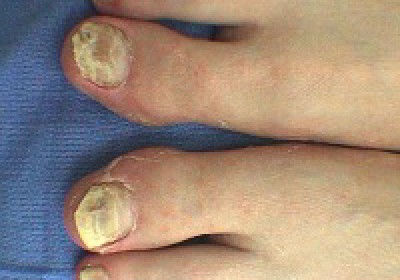 feet nail fungus