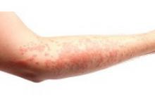 eczema